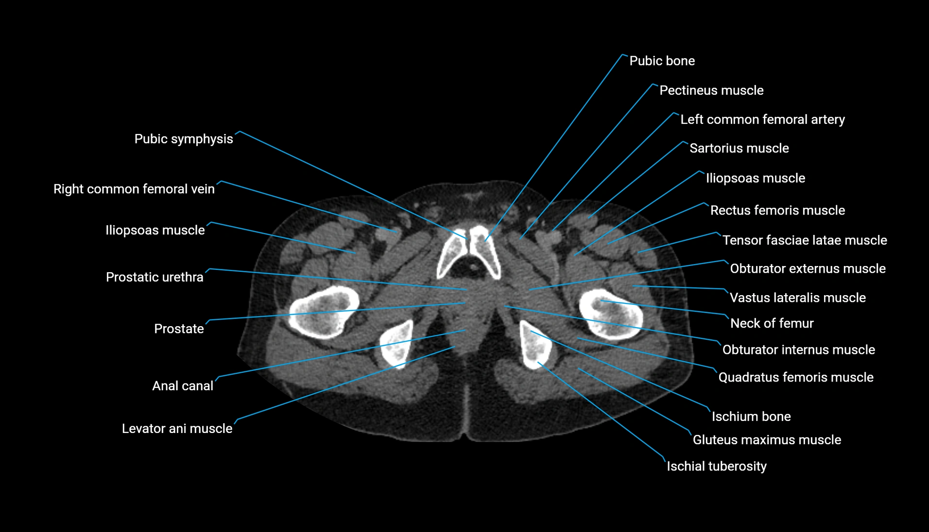 CT urogram axial cross sectional anatomy  labelled radiology image-00256.webp